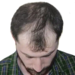 hair transplants Manchester before and after