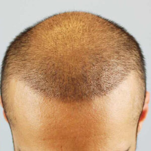 hair transplant cost in England