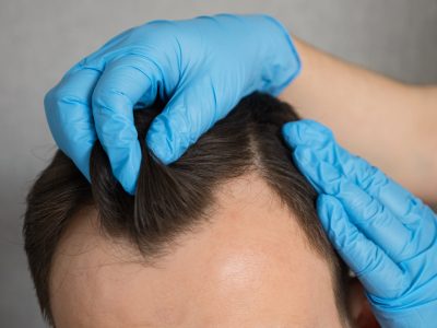 Fue Hair Transplant cost